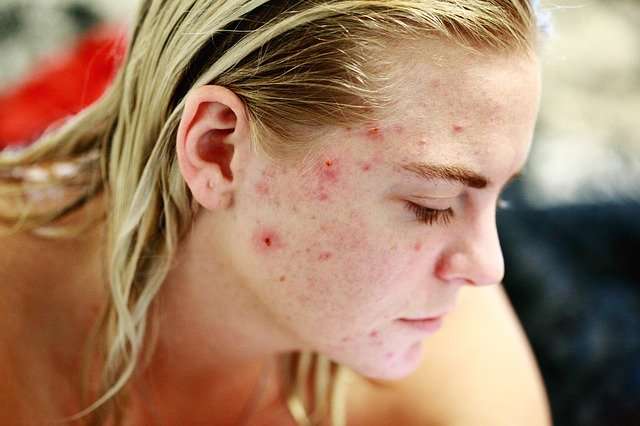 How To Treat Acne Effectively At Home